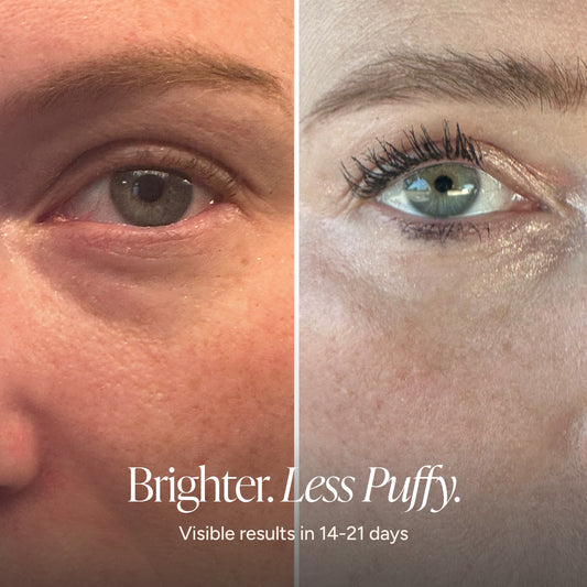 A close-up before-and-after comparison of a person's eye area, showing a puffy, sun-drenched left eye on the left and a brighter, more refreshed right eye on the right. Text at the bottom reads 'Brighter.
