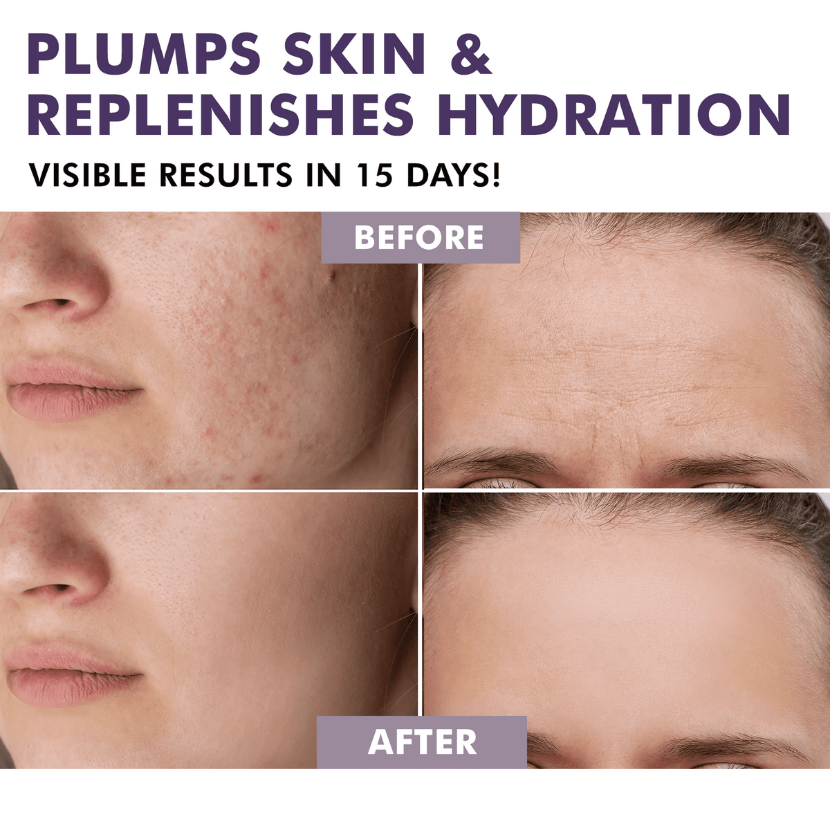 BEFORE AFTER ACNE