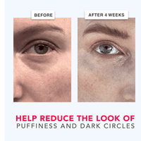 Before and after comparison of eye area treatment showing reduced puffiness and dark circles.