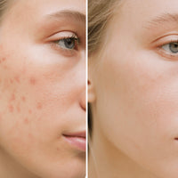 Before and after comparison of a person's face with acne on one side and clear skin on the other.